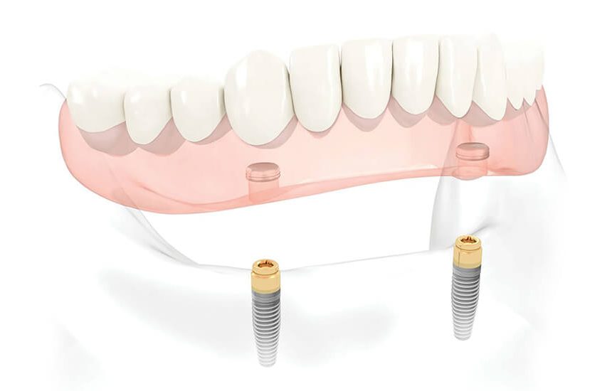 Implant Retained Dentures