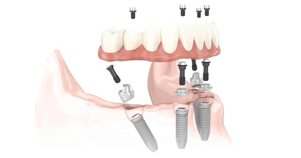 Implant Supported Dentures