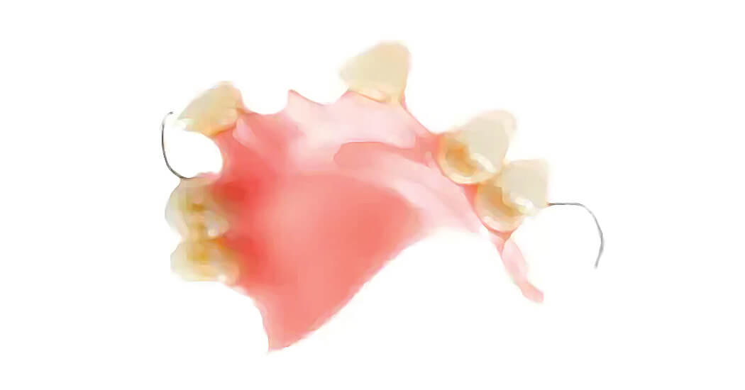 Conventional Partial Dentures